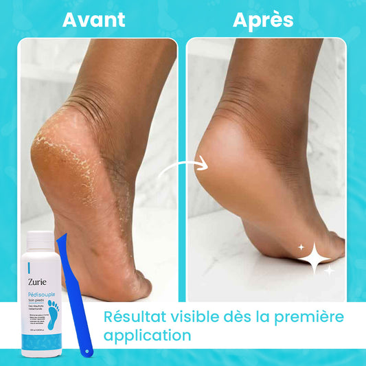 Lotion exfoliante zurie